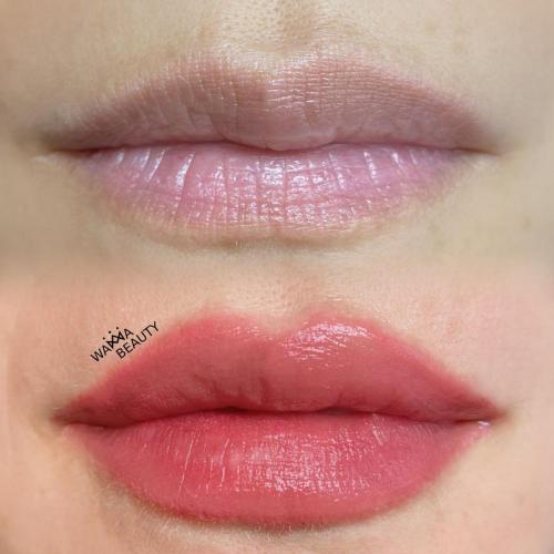 LIP ENHANCEMENT